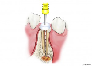 感染根管治療2　根のお薬の除去